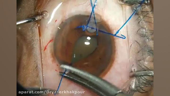 عمل جراحی آب مروارید دکتر یاسر خاکپور جراح و متخصص چشم جراحی بینی