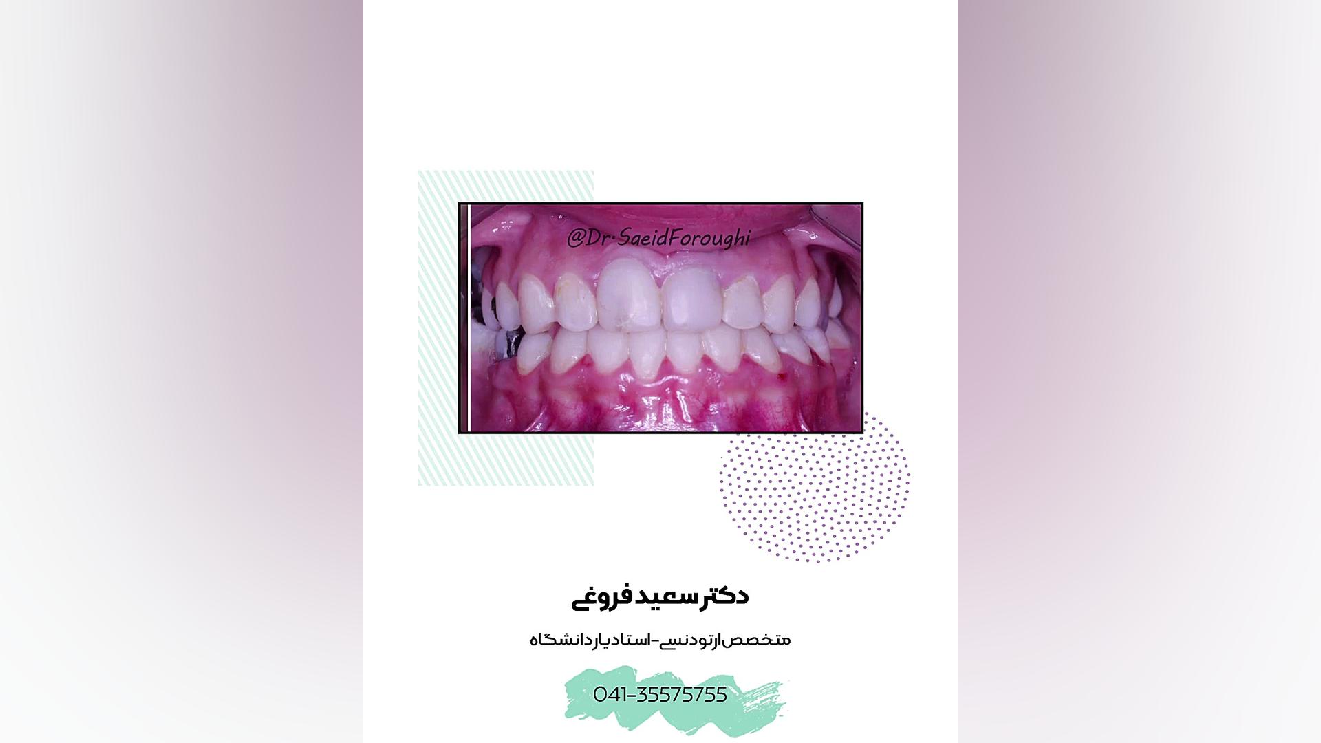 اصلاح کراس بایت قدامی و طرفی (انحراف فک پایین به سمت جلو و سمت چپ) در مراجعه کنن دکتر سعید فروغی متخصص ارتودنسی