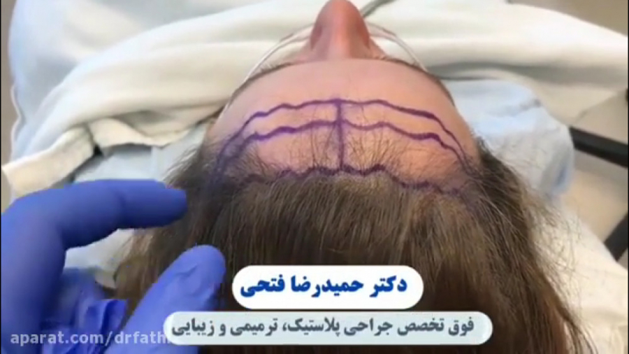 لیفت پیشانی و شقیقه با نخ دکتر حمید رضا فتحی فوق تخصص جراحی پلاستیک