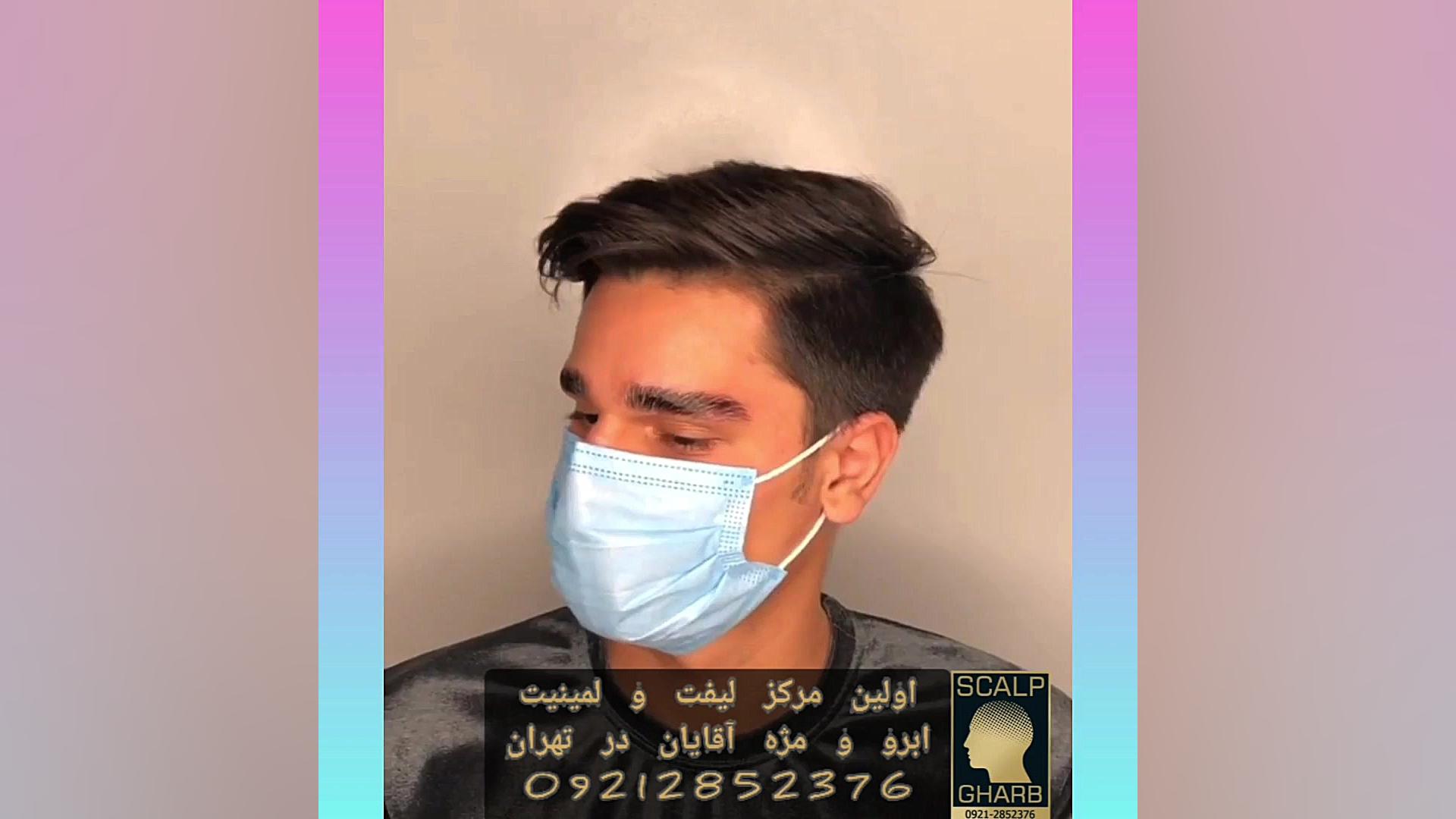 لیفت ابرو آقایان بیماری ترومبوسایتوز اسنشیال