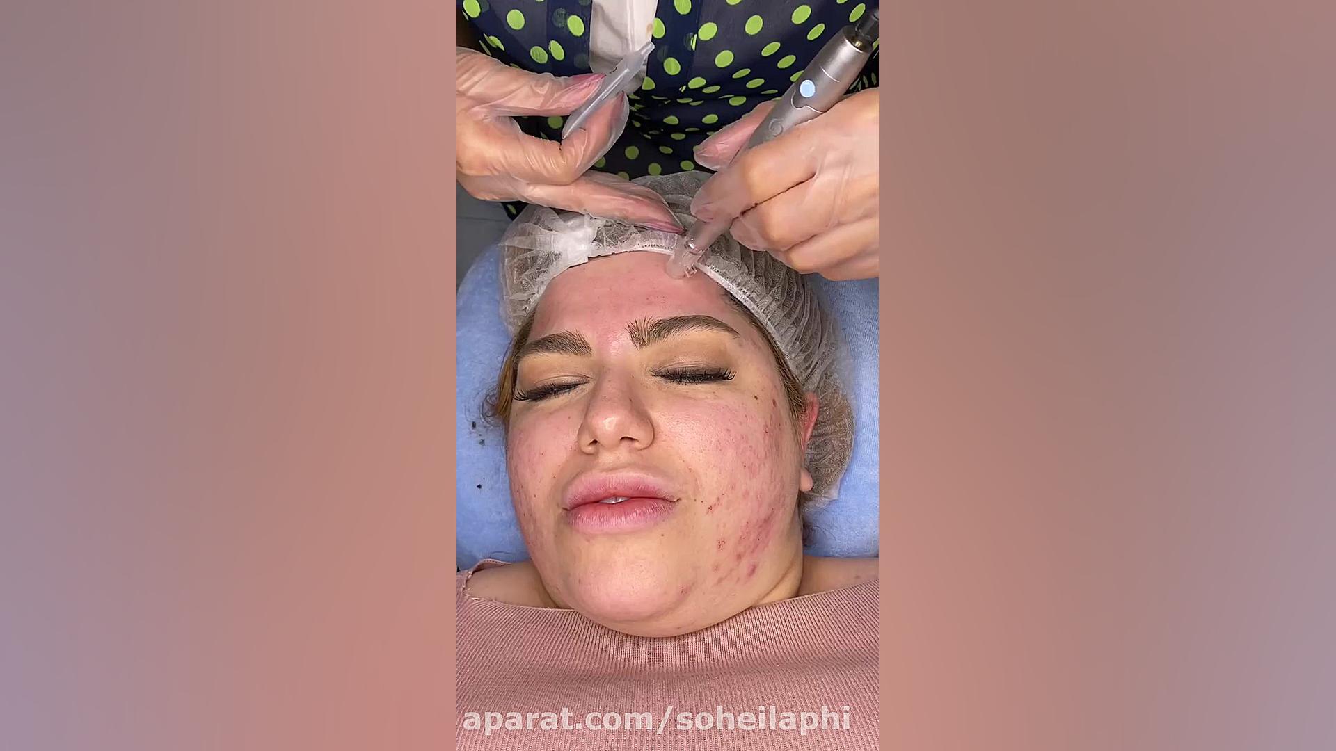میکرونیدلینگ صورت پلاستیک لثه