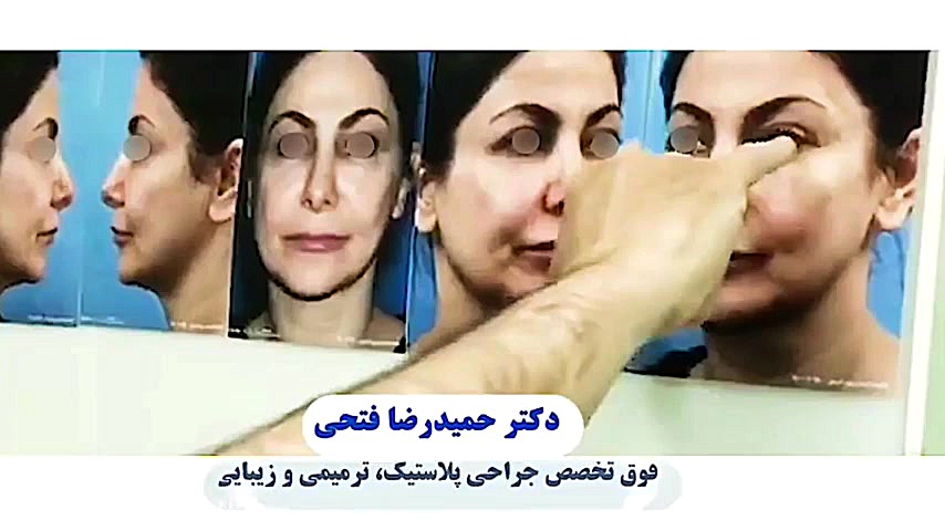 فیلم واقعی جراحی لیفت پیشانی با آندوسکوپی و جراحی پلک دکتر حمید رضا فتحی فوق تخصص جراحی پلاستیک