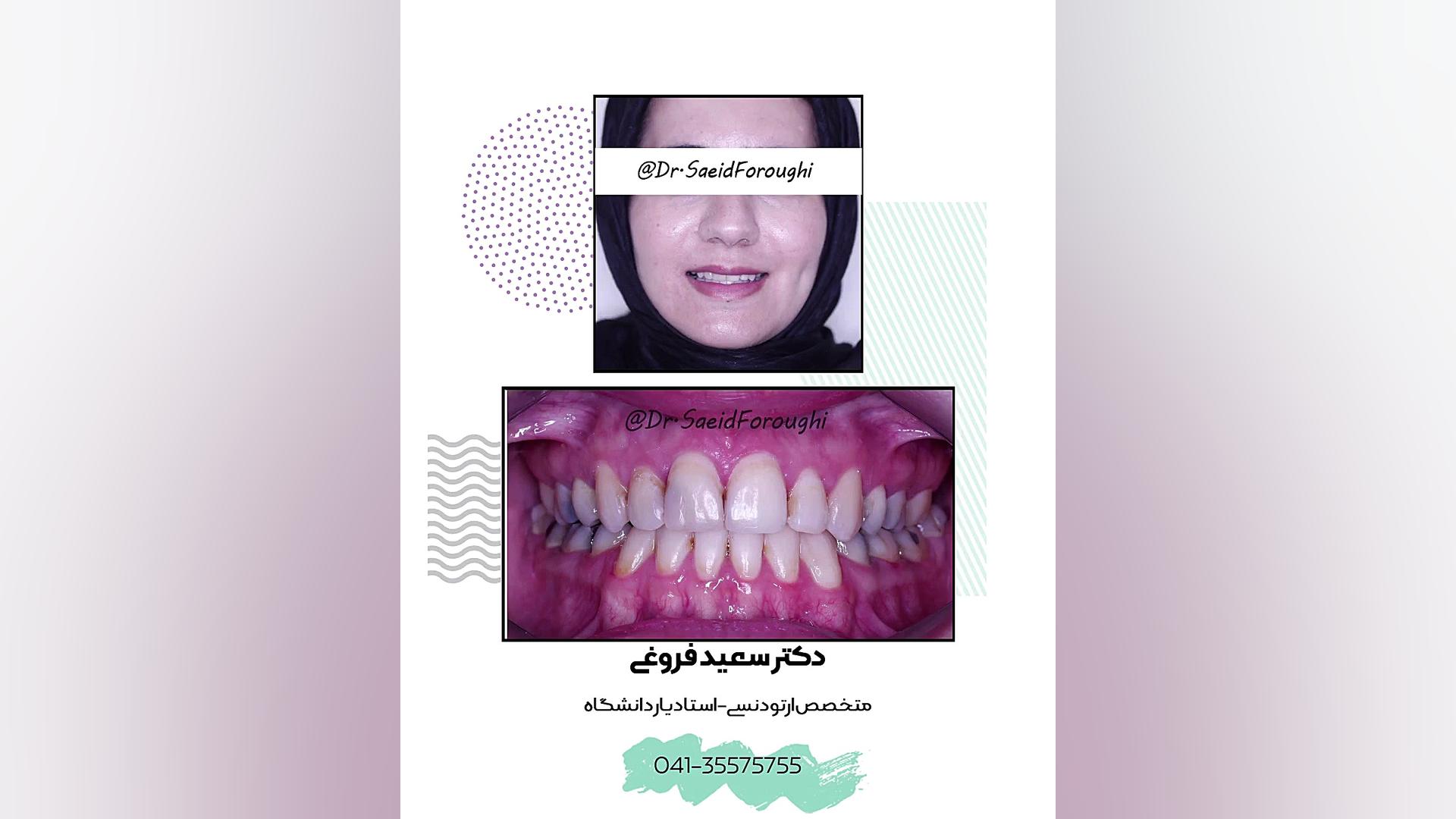 اصلاح بینظمی و کمبود فضای دندانی و به قوس آوردن دندان نیش نهفته سمت چپ فک پایین دکتر سعید فروغی متخصص ارتودنسی