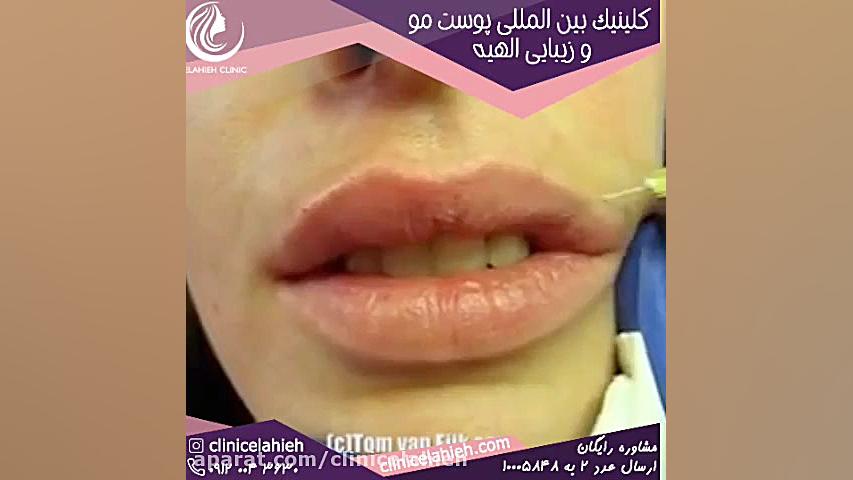 همه چیز در خصوص تزریق ژل به لب مزایا و معایب ماندگاری هزینه ارنیزوماب