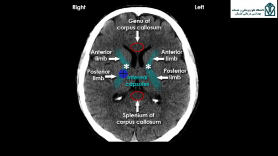 آموزش تفسیر Brain CT Scan (قسمت سوم) میکرونیدلینگ