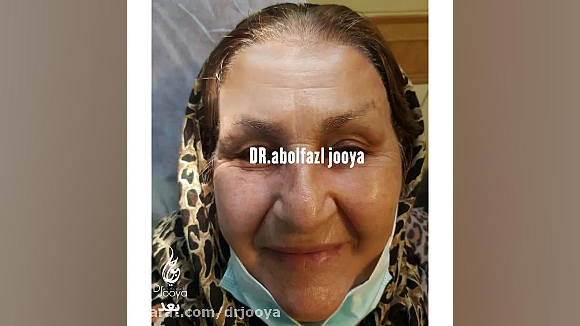 نمونه لیفت صورت توسط دکتر جویا متخصص پوست اصفهان جرمگیری