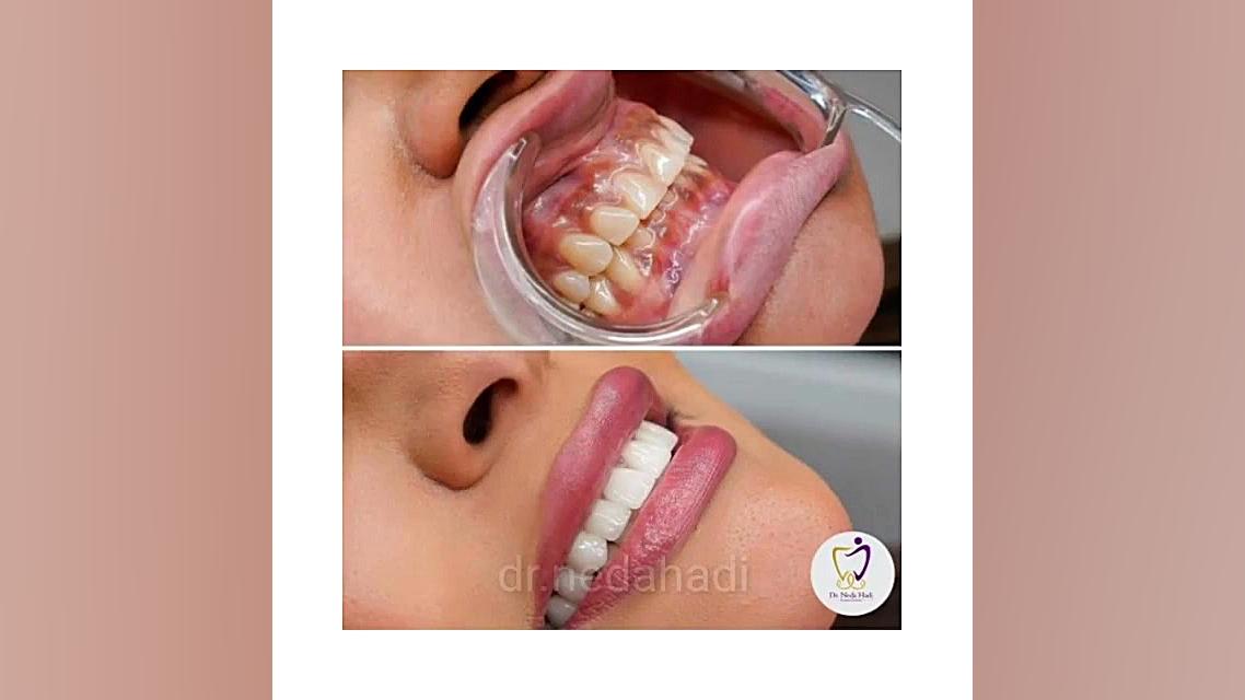 انجام کار زیبایی برای مراجعه کننده عزیزم دکتر ندا هادی-دندانپزشک زیبایی