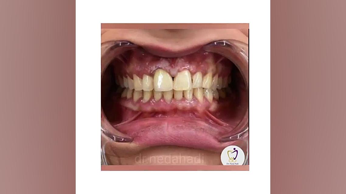انجام کار زیبایی برای مراجعه کننده عزیز دکتر ندا هادی-دندانپزشک زیبایی