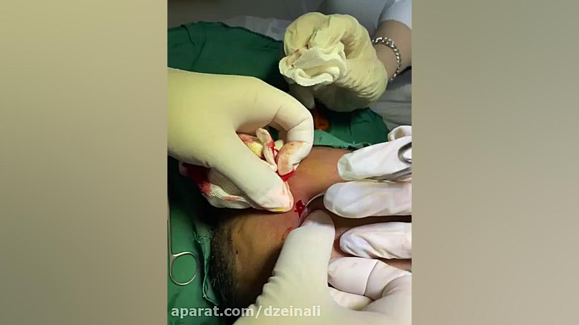 جراحی کیست پیلار ناحیه کف سر دکتر فرحناز زینعلی - متخصص پوست، مو، زیبایی زنجان