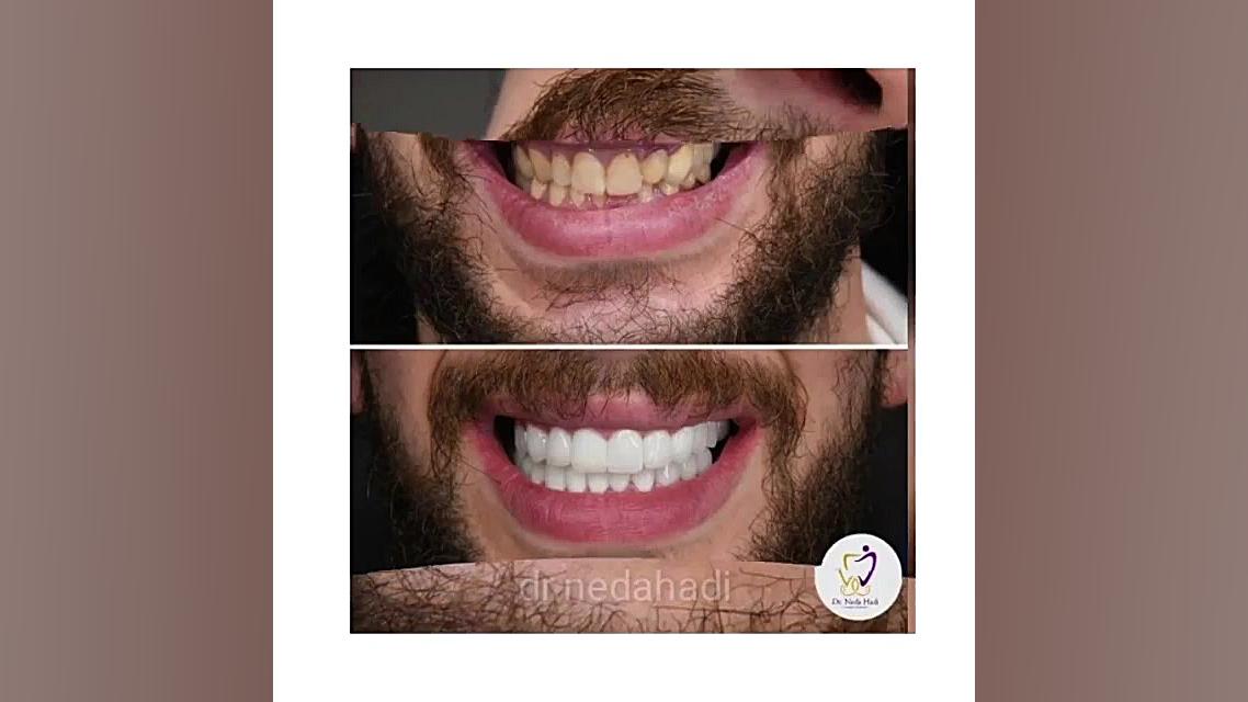 طراحی لبخند زیبا برای مراجعه کننده عزیز دکتر ندا هادی-دندانپزشک زیبایی