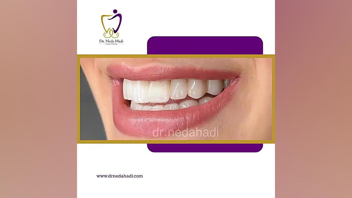 دکتر ندا هادی دندانپزشک زیبایی و ترمیمی دندان کپسول اندوسکوپی
