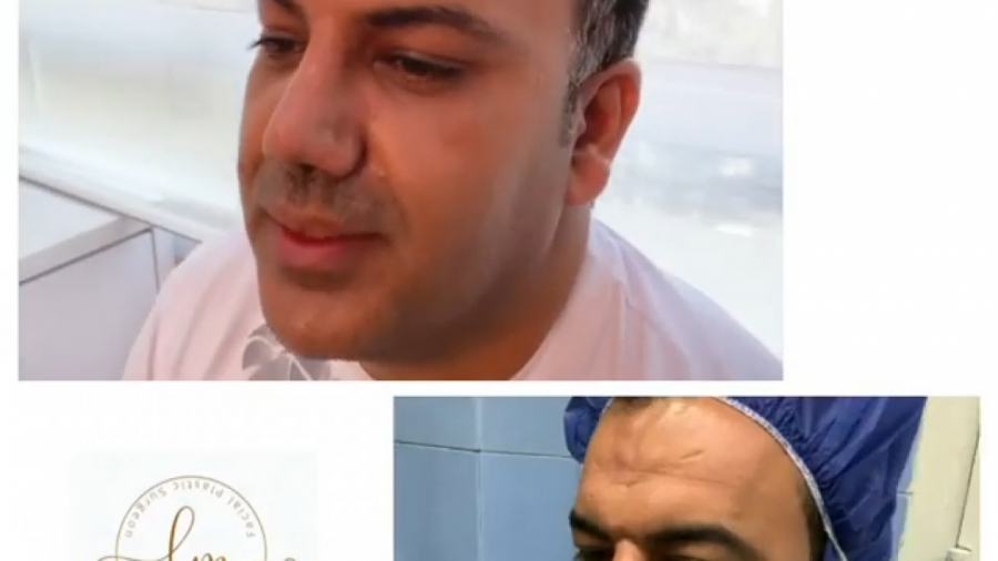 تجربه بیمار از عمل همزمان عمل بینی و لیفت پیشانی سندرم نفروتیک ارثی