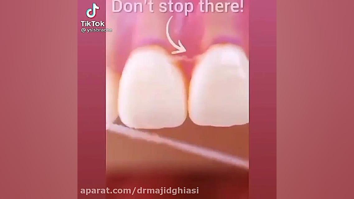 بهداشت دهان و دندان-استفاده صحیح از نخ دندان دکترمجیدقیاسی