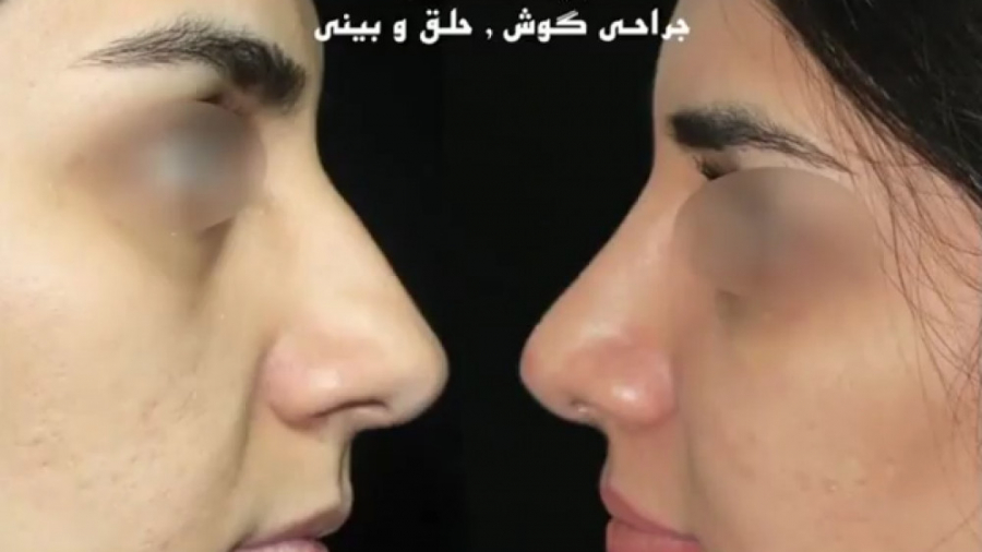 6 ماه بعد از عمل بینی غضروفی توسط دکتر امید ابراهیمی دکتر امید ابراهیمی