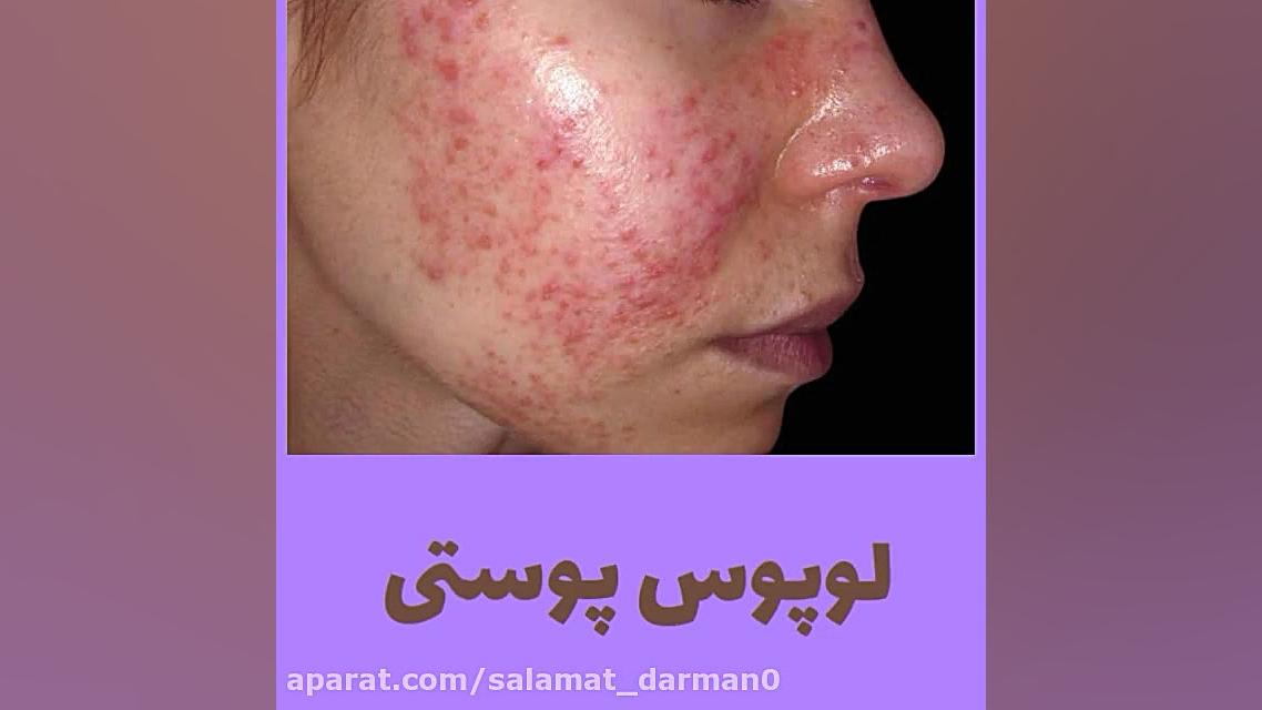 لوپوس پوستی لیفت گردنایمپلنت دندان