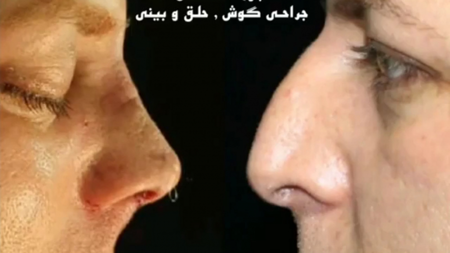 رینوپلاستی توسط دکتر امید ابراهیمی بهترین جراح بینی در تهران دکتر امید ابراهیمی