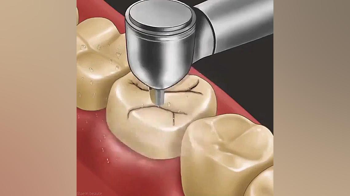 اموزش ترمیم دندان دستگاه آنالیز اگزوزوم