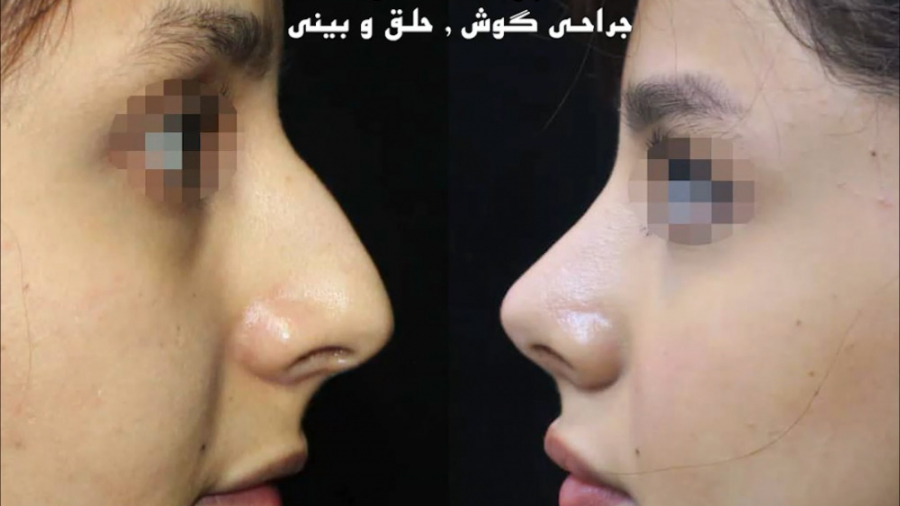 عمل بینی استخوانی توسط دکتر امید ابراهیمی بهترین جراح بینی در تهران دکتر امید ابراهیمی