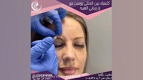 لیفت ابرو با بوتاکس بیورآکتور سه‌بعدی