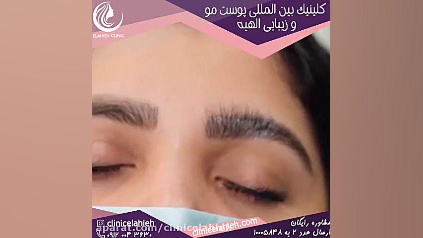 لیفت ابرو در خانه Synaptic Vesicle Tracking
