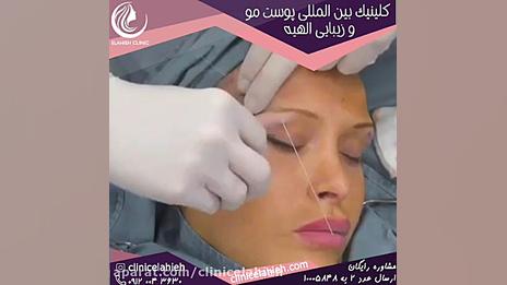 لیفت ابرو با نخ دستگاه پلاسمای سرد