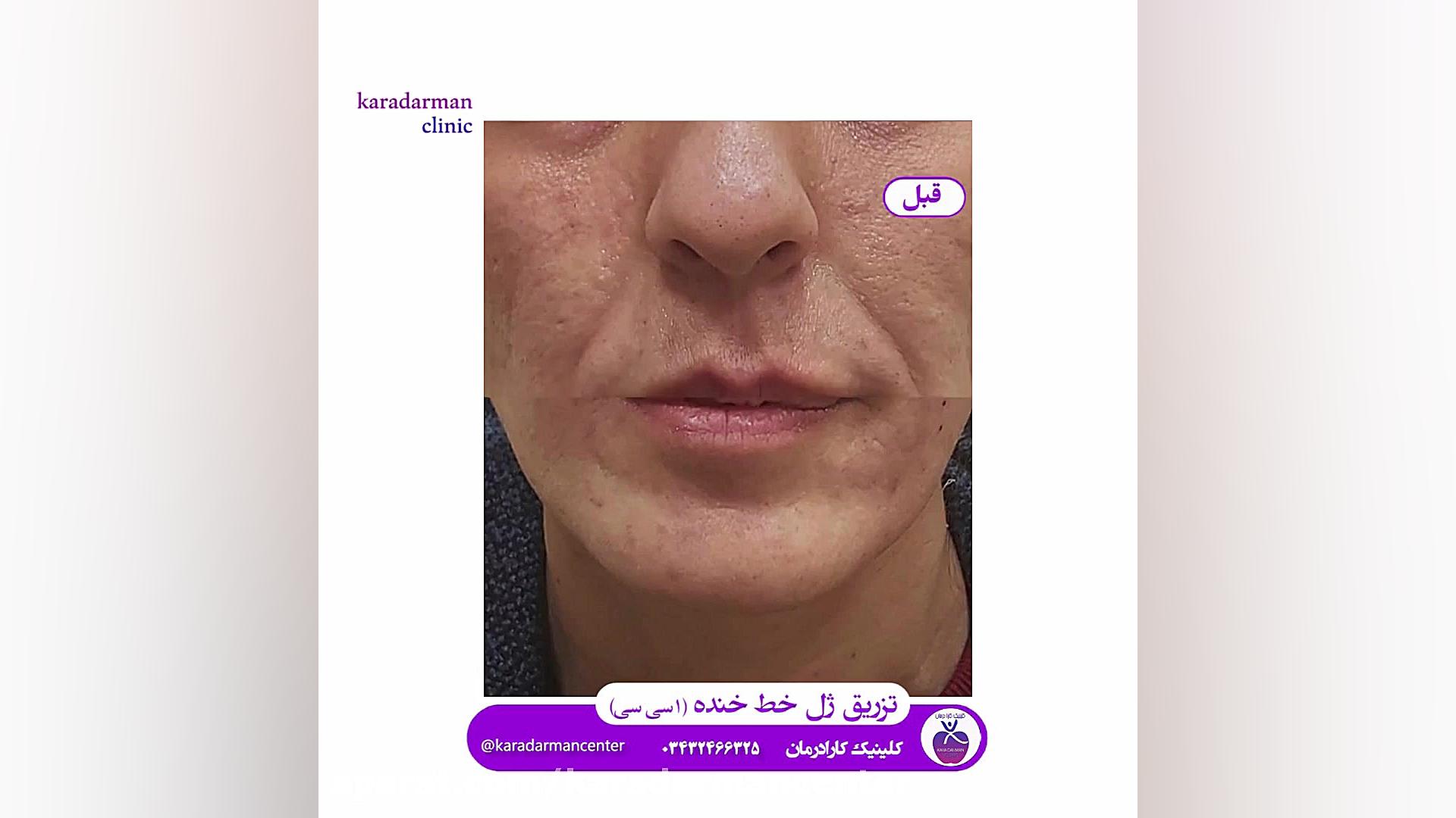 فیلم قبل و بعد تزریق ژل خط خنده کاتاپلکسی