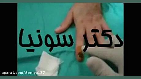 خون مردگی زیر ناخن زمان170ثانیه