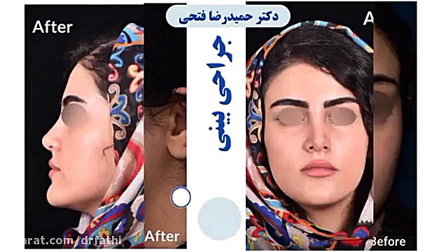 جراحی بینی متناسب با چهره فرد دکتر حمید رضا فتحی فوق تخصص جراحی پلاستیک