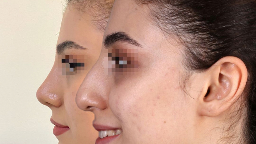 بینی طبیعی با قوس ملايم که در عمل زیبایی بینی استخوانی می بینید!!!