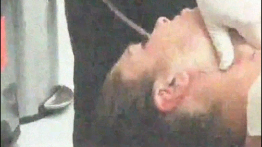 لیپوساکشن غبغب لیزر مو
