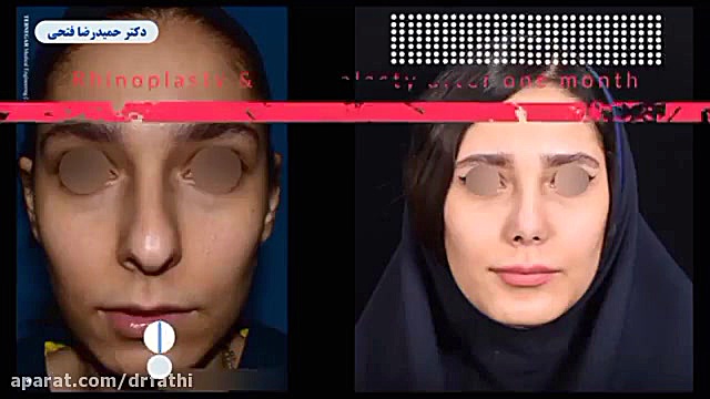 جراحی زیبایی چانه و بینی بطور همزمان دکتر حمید رضا فتحی فوق تخصص جراحی پلاستیک