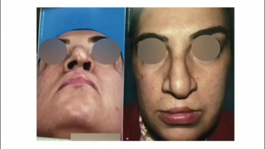 فیلم عمل قوز بینی و افتادگی نوک بینی دکتر حمید رضا فتحی فوق تخصص جراحی پلاستیک