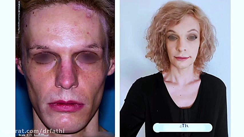 عمل تغییر جنسیت مرد به زن دکتر حمید رضا فتحی فوق تخصص جراحی پلاستیک