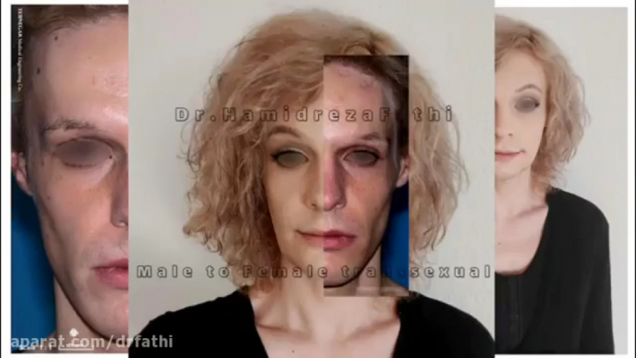 فیلم واقعی عمل جراحی تغییر جنسیت از مرد به زن دکتر حمید رضا فتحی فوق تخصص جراحی پلاستیک