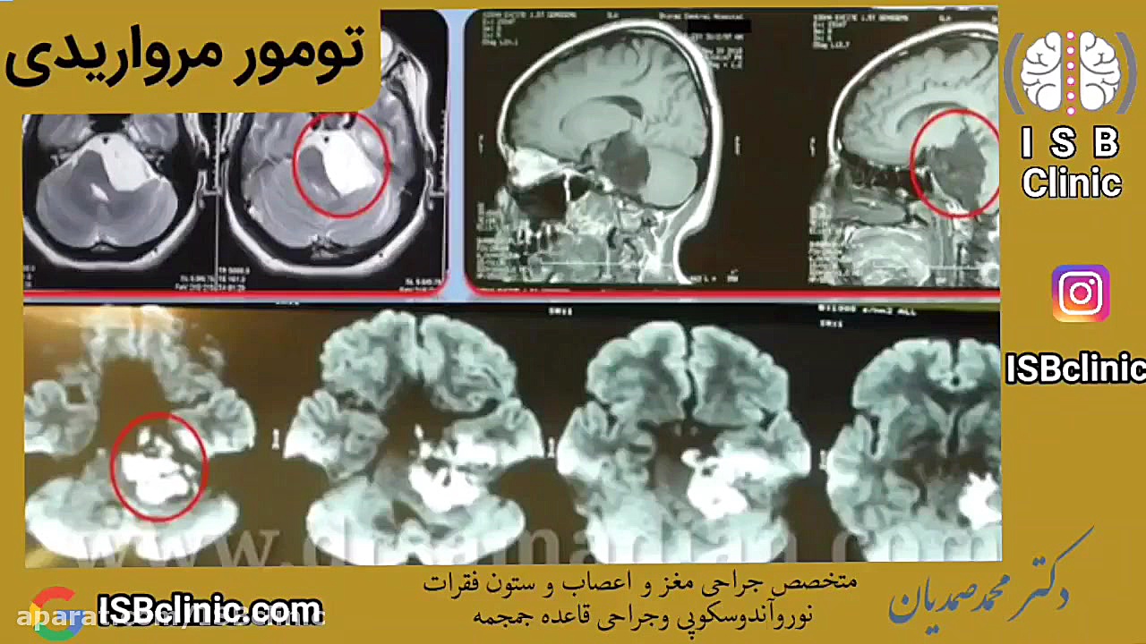 جراحی تومور اپیدرموئید (تومور مرواریدی) کاشت مو