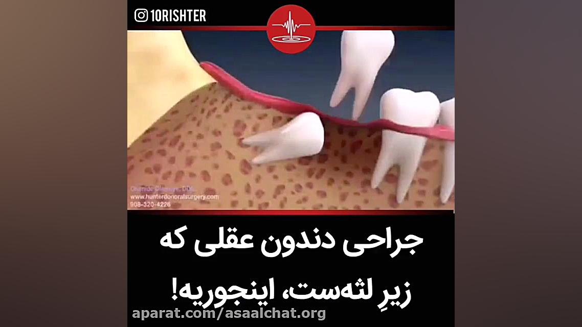 جراحی دندان عقل در زیر لثه... اولتراسوند پرتابل جیبی