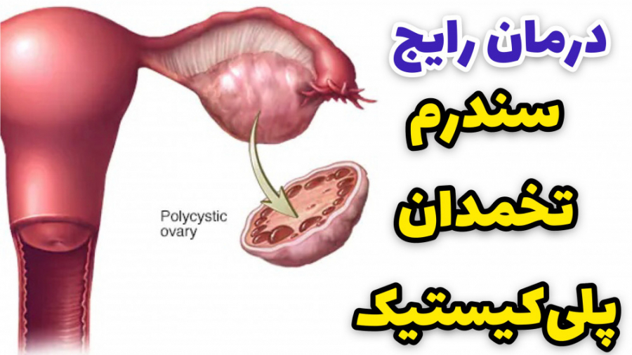 درمان سندرم تخمدان پلی کیستیک (تنبلی تخمدان) چیست؟ پوسیدگی دندان