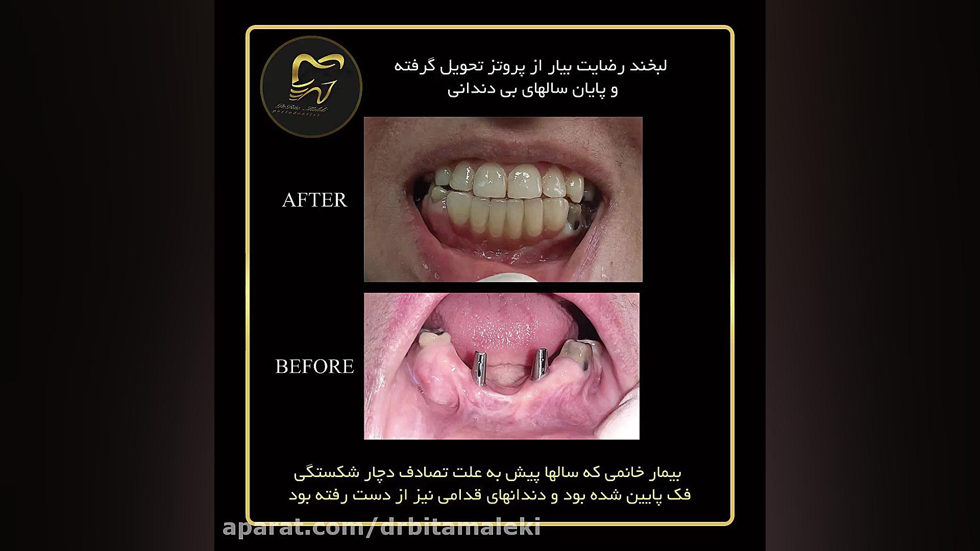 پروتز دندان تزریق بوتاکس