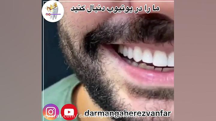زيبايي دندان با كامپوزيت ونير آزمون آلدوستِرون پلاسما