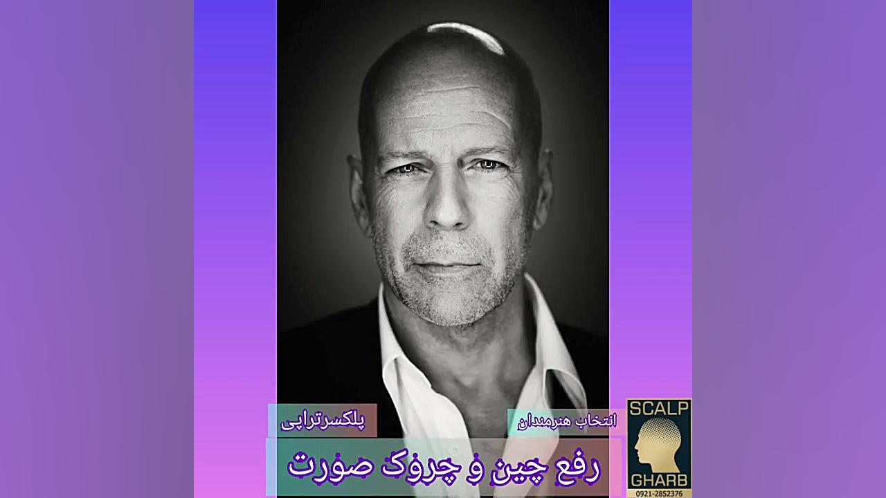 رفع چین و چروک صورت با پلکسر رادیوگرافی دندان