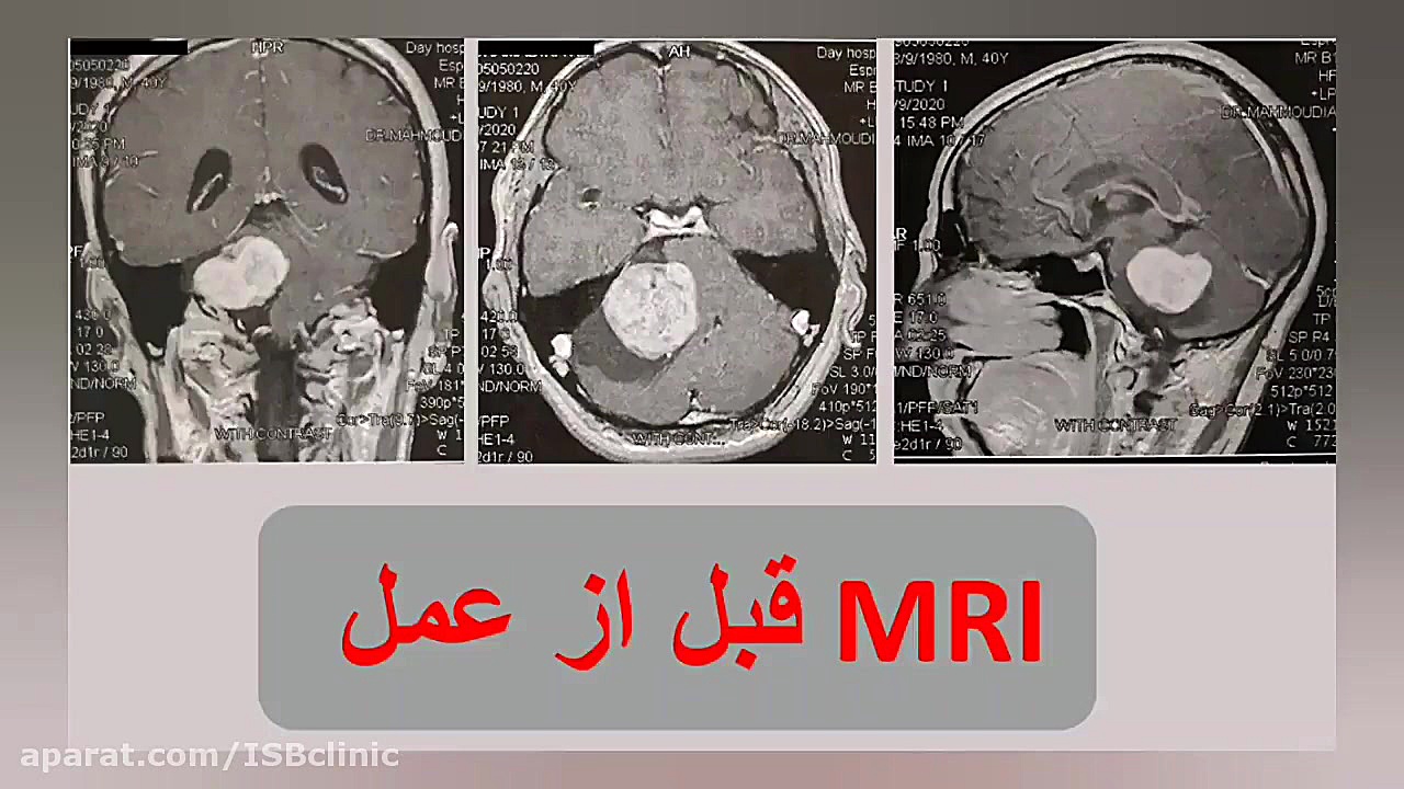 تومور شوانوم CPA بزرگ بررسی لک صورت