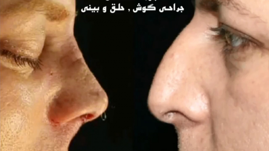 عمل بینی زیبایی توسط دکتر امید ابراهیمی بهترین جراح بینی در تهران دکتر امید ابراهیمی