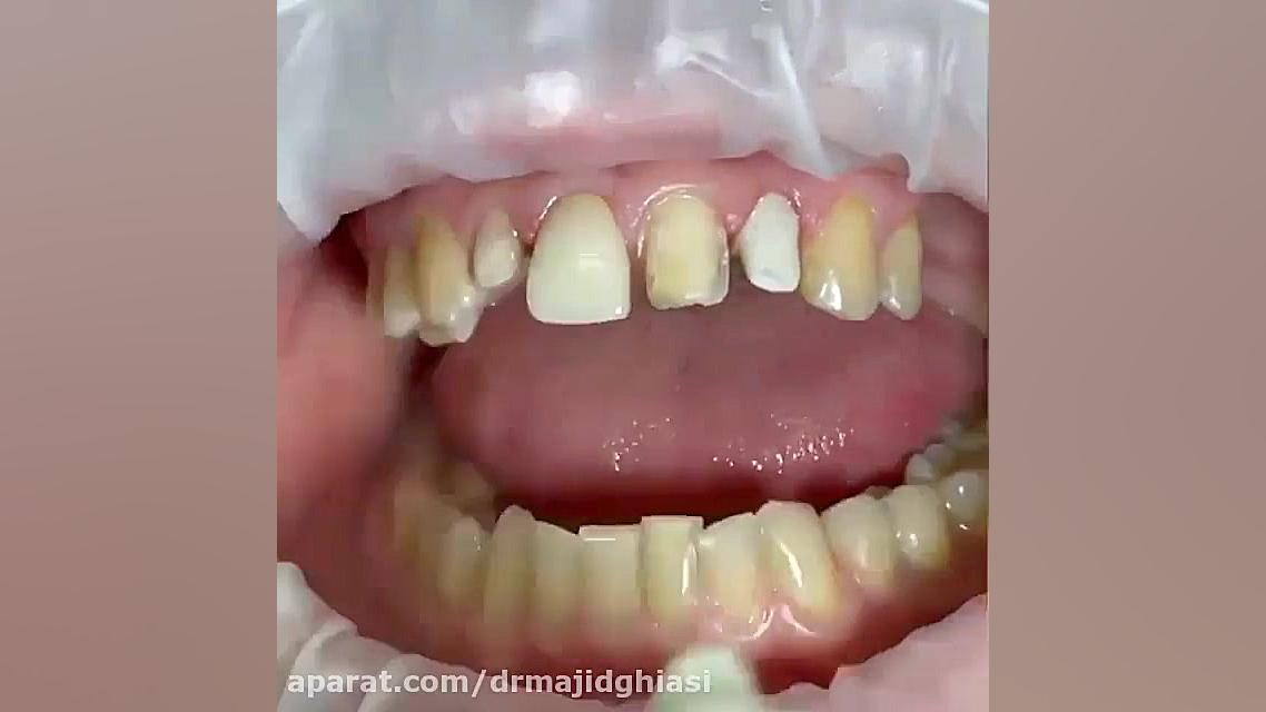 ونیر دندانی دکترمجیدقیاسی