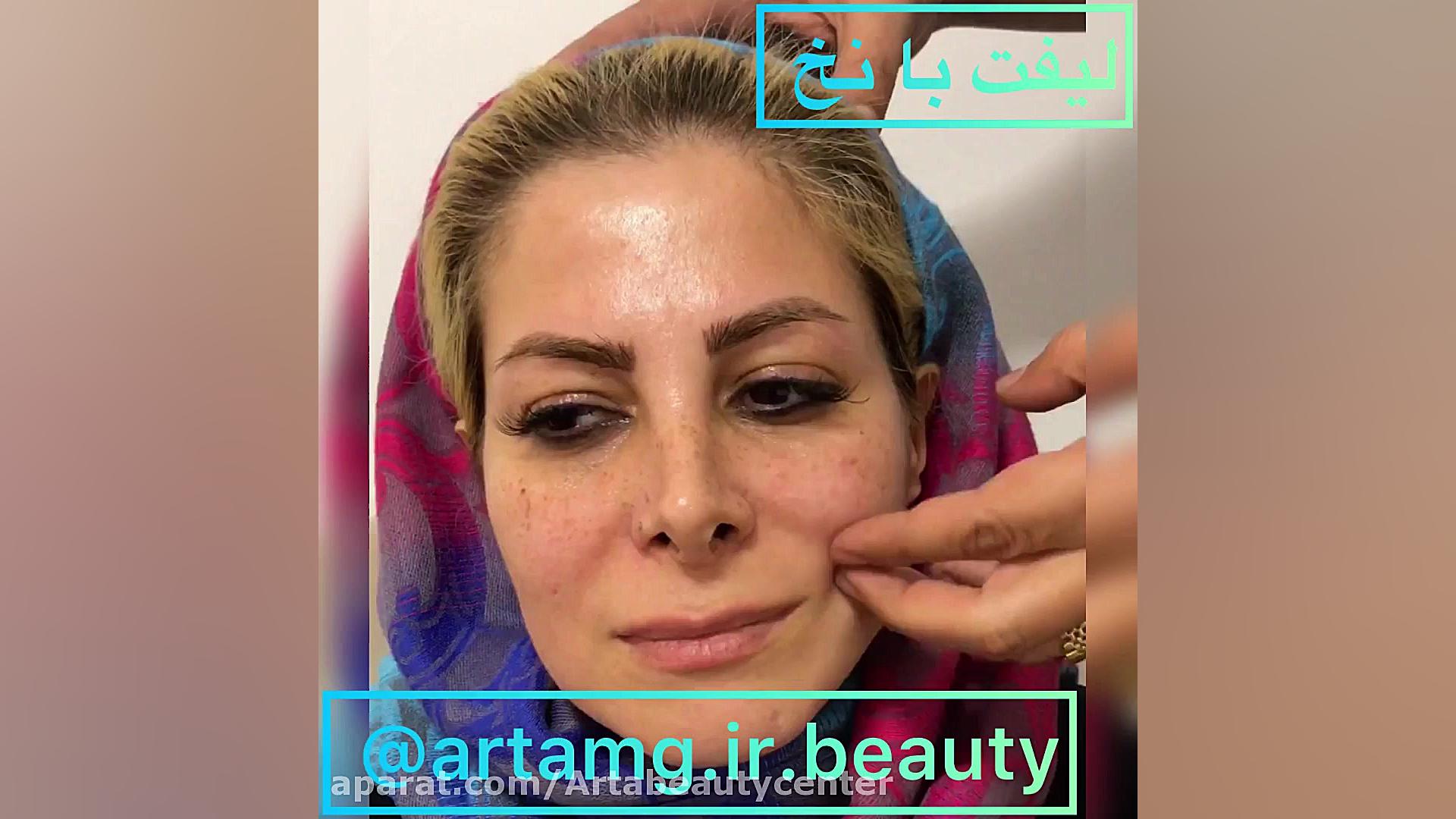 ليفت و جوانسازي صورت توسط نخ هاي كاگ روکش دندان