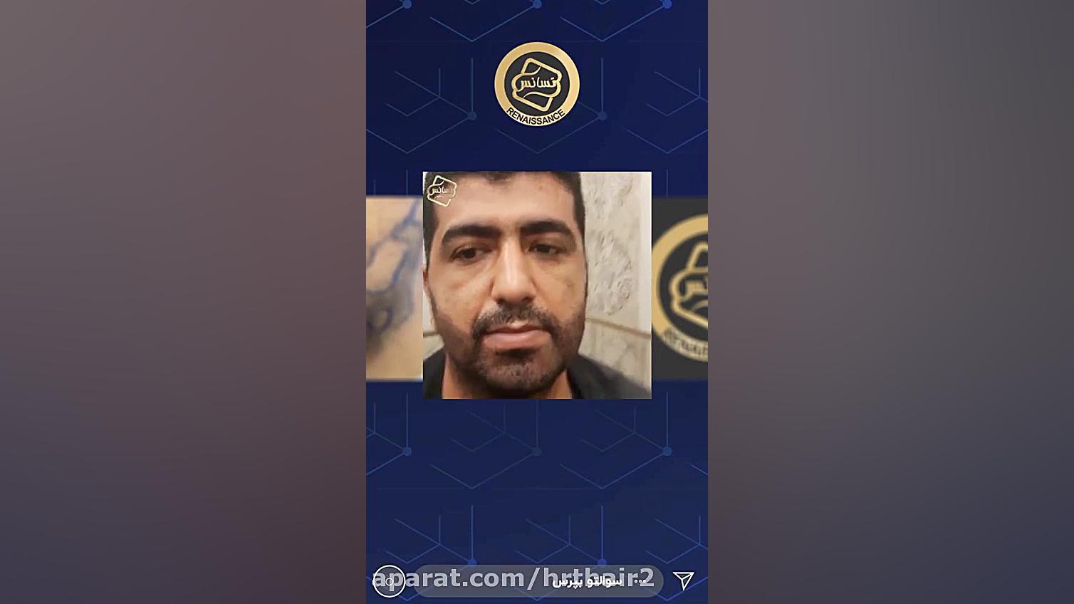 کاشت ریش پزشکی دریایی
