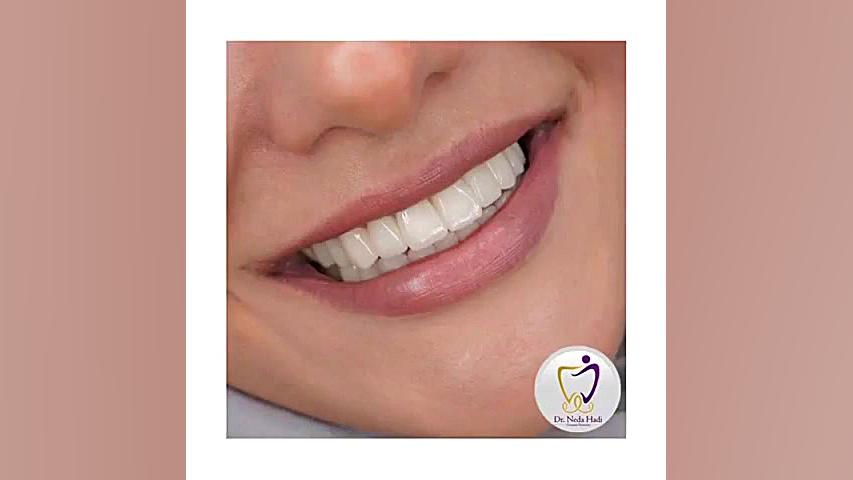 انجام لمینت برای مراجعه کننده عزیز دکتر ندا هادی-دندانپزشک زیبایی