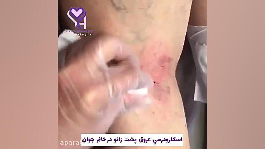 فیلم واقعی اسکلرودرمی عروق پشت زانو در خانم جوان گوهر خیراندیش