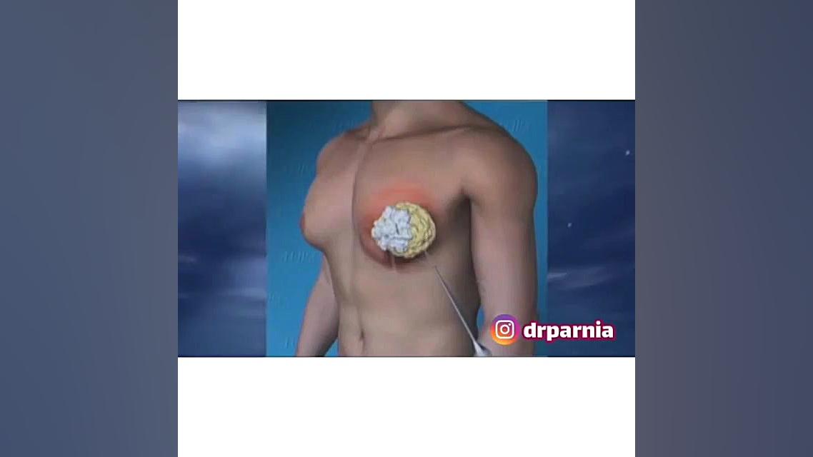 جراحی ژنیکوماستی دکتر رفیع پرنیا فوق تخصص پلاستیک