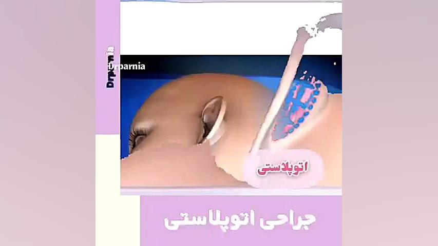جراحی اتوپلاستی دکتر رفیع پرنیا فوق تخصص پلاستیک
