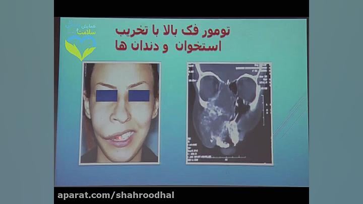 راههای جراحی فک و صورت و تاثیر آن بر بهبود سلامت مردم.دکتر علی حسنی عصب‌کشی